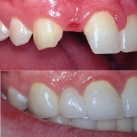 aadic kollam dental clinic - Fixed Partial Dentures